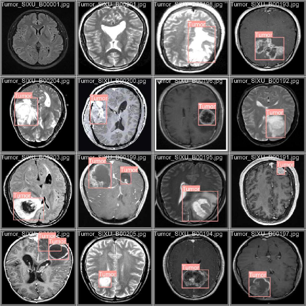 脑肿瘤检测结果展示